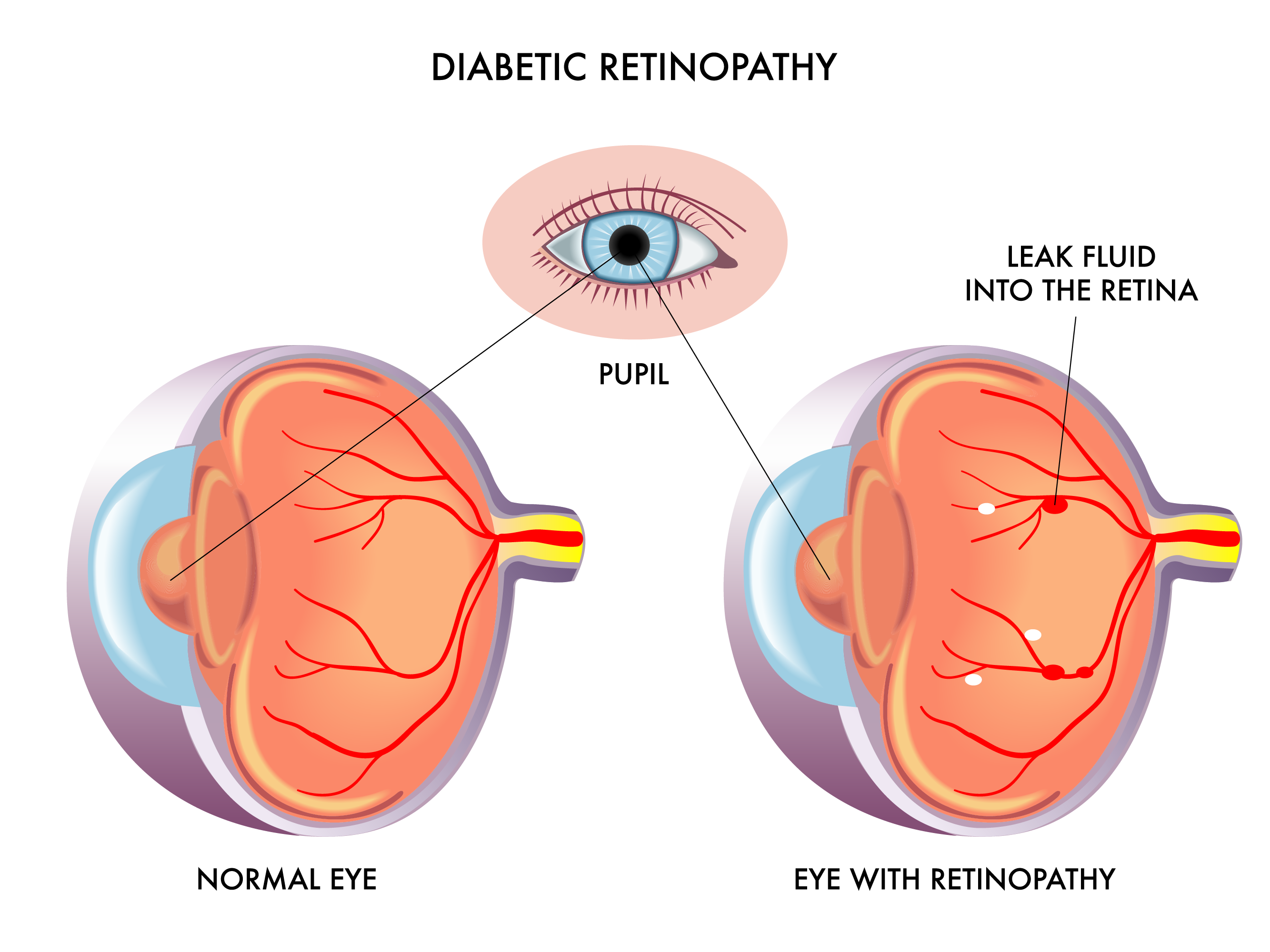 DIABETIC EYE DISEASE Image