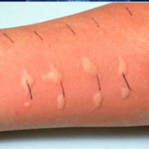 SKIN TESTING FOR ALLERGIES – BASICS Image